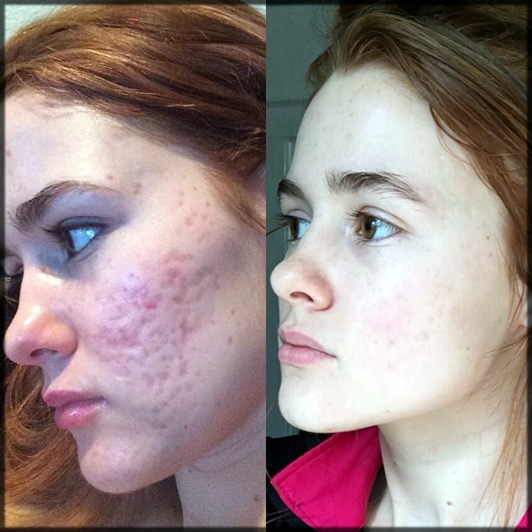 Pimple Marks before and after