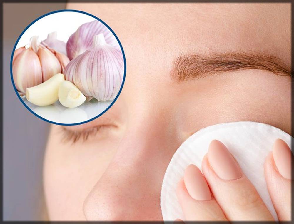 Garlic as a home remedy for skin tags