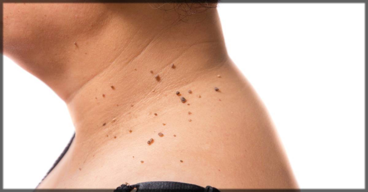 skin tags on neck region